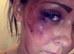 19-årig blev overfaldet i nat – nu efterlyser hun overfaldsmanden på Facebook